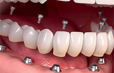 Rehabilitación 6 implantes y 12 coronas