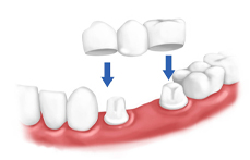 Puente con 2 muñones y un pontico
