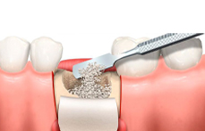 Injerto hueso con regeneración ósea