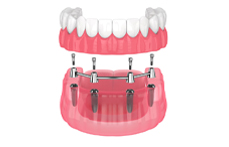 Sobredentadura con 4 implantes y barra
